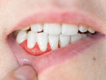 How Long Does Cut Gum Take to Heal