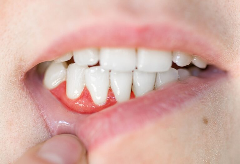 How Long Does Cut Gum Take to Heal