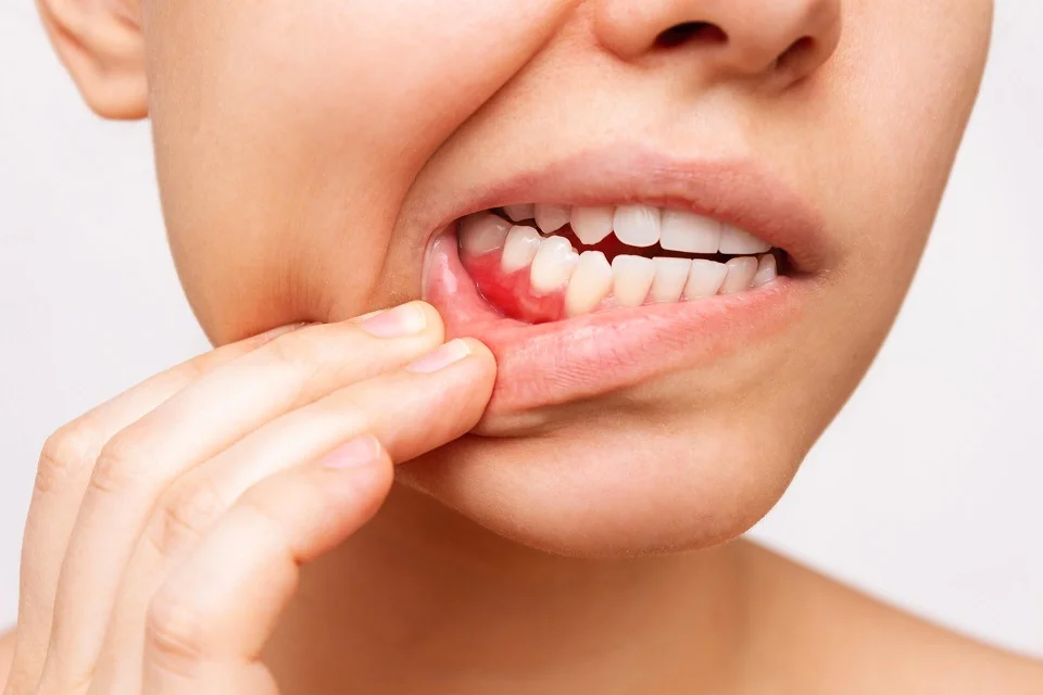 How do different factors impact gum healing time