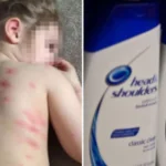 Can We Use Shampoo During Chicken Pox