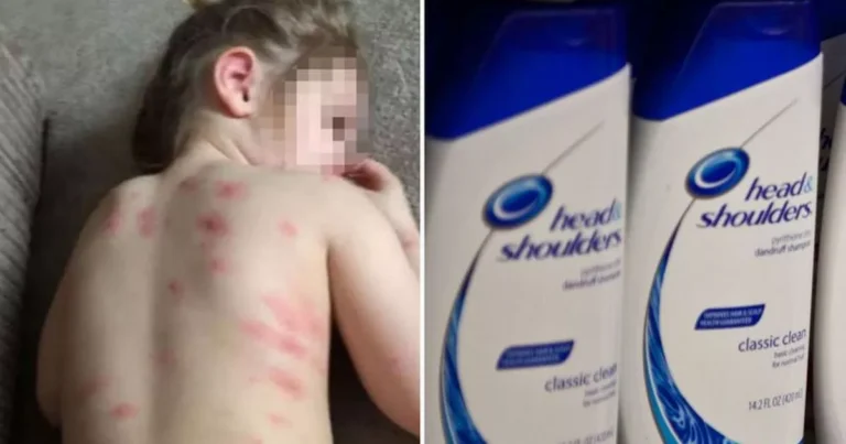 Can We Use Shampoo During Chicken Pox