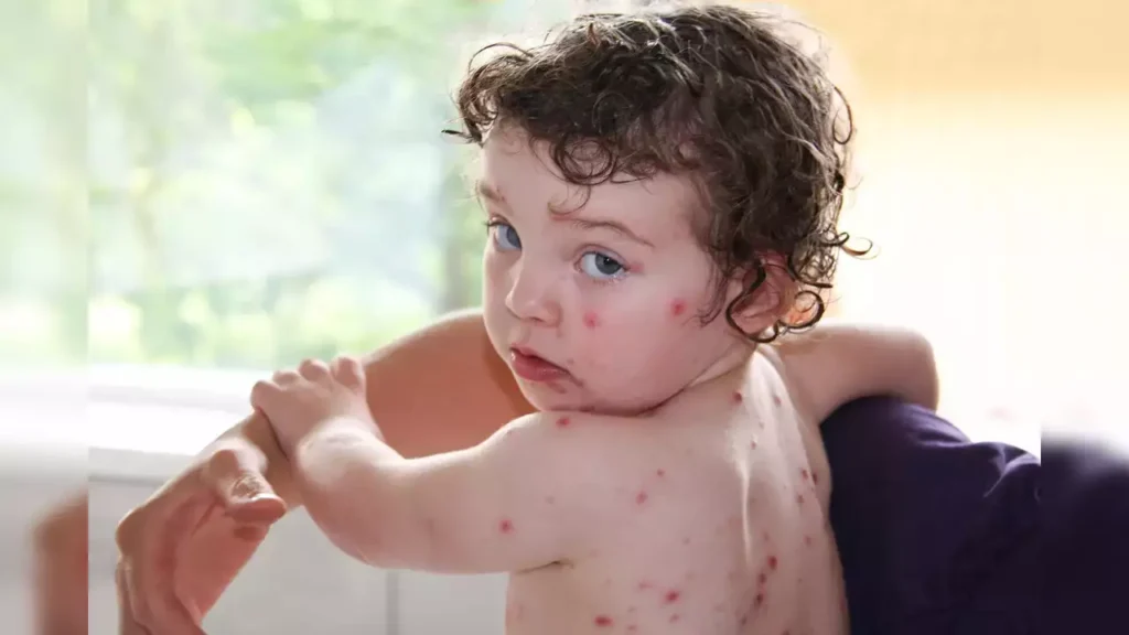 General Recommendations for Shampoo Use During Chickenpox
